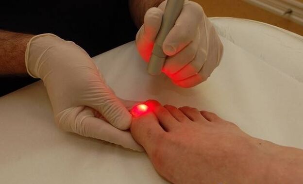 laserová léčba plísní nehtů na nohou