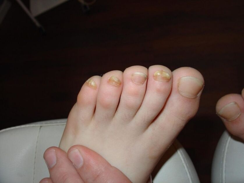 příznaky plísně nehtů na nohou