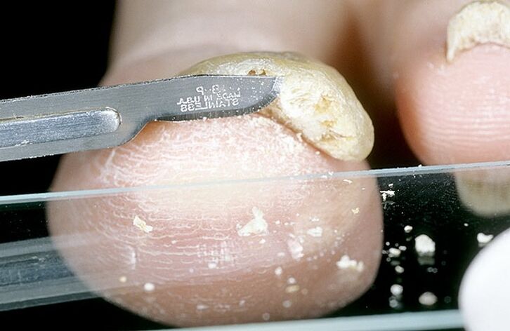 škrábání nehtů k diagnostice houby