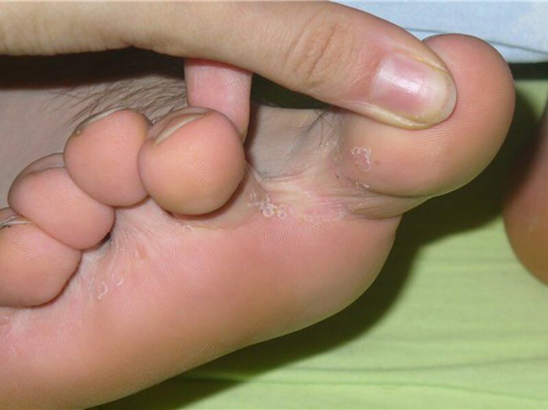 příznaky plísně na nohou