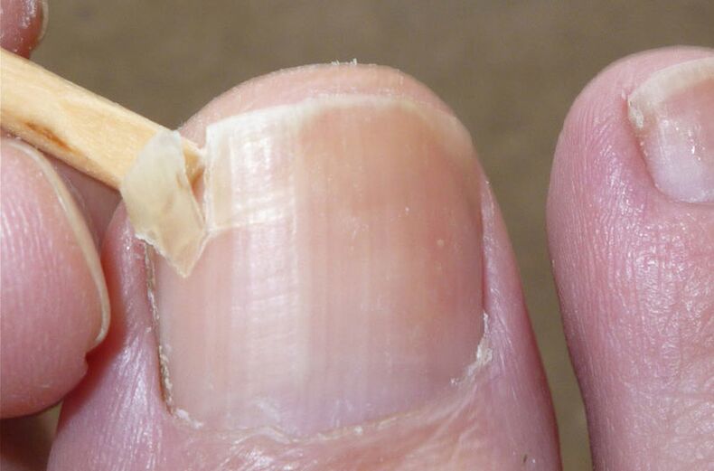 Poškozené nehty jsou rizikovým faktorem pro plísňovou infekci