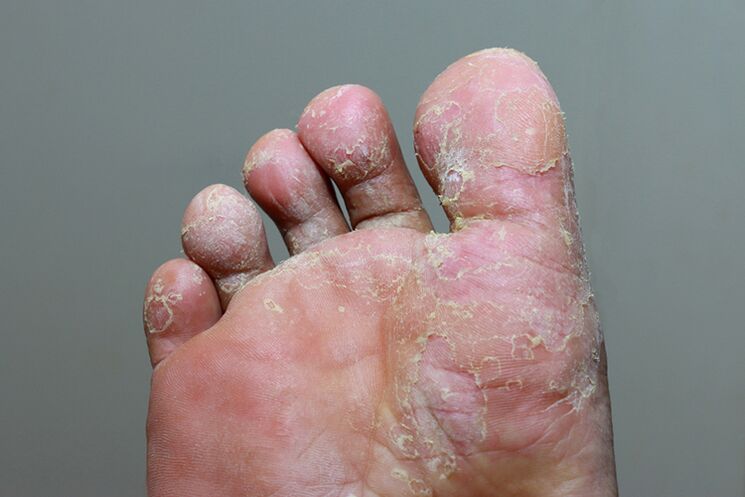 Těžká fáze mycosis kůže prstu