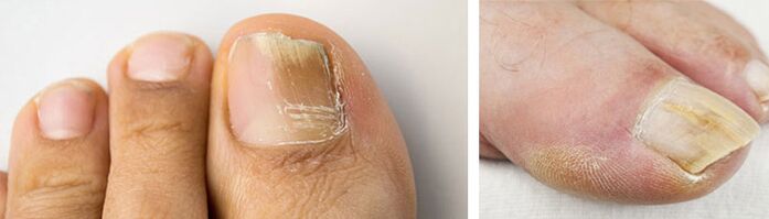 fotografie plísňové infekce na nehtu palce