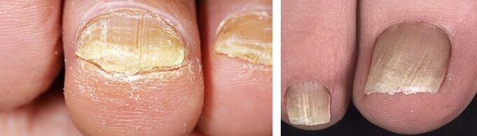 poškození nehtů plísňovou infekcí
