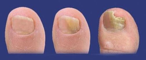 stadia vývoje houby na nehtech na nohou