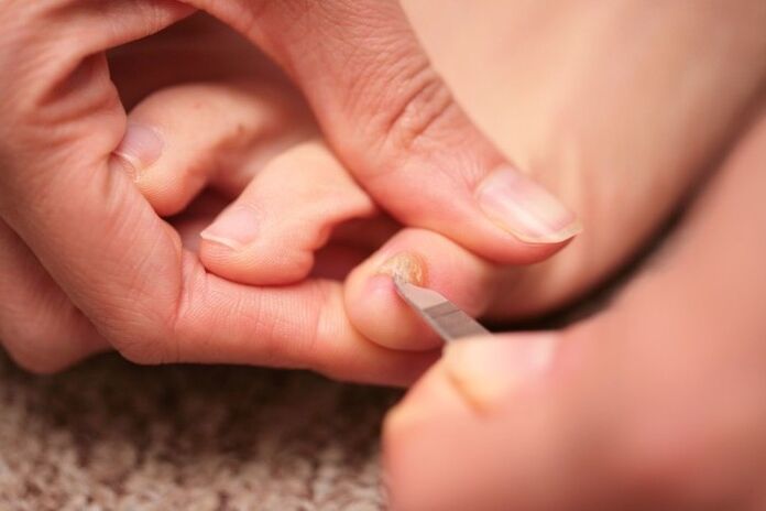 Antifungální ošetření nehtů